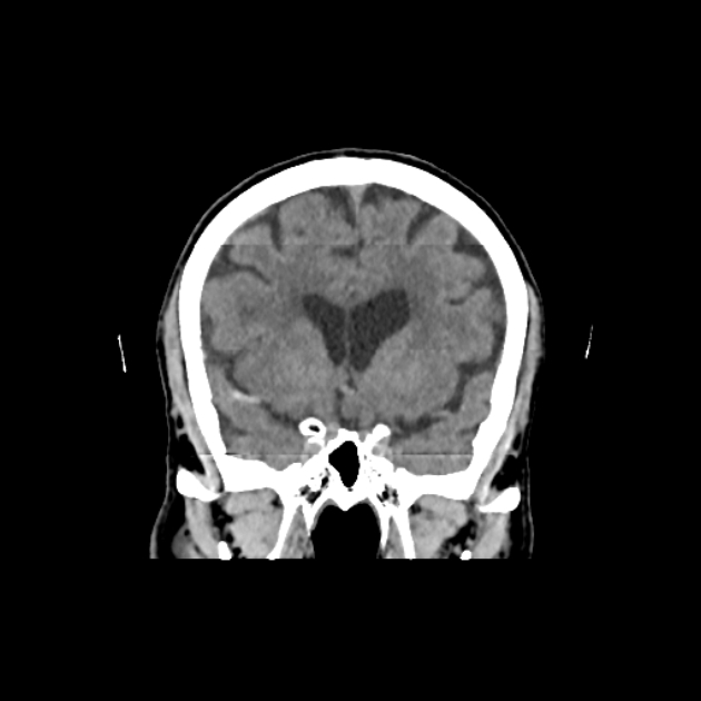 Hyperdense MCA sign | Image | Radiopaedia.org