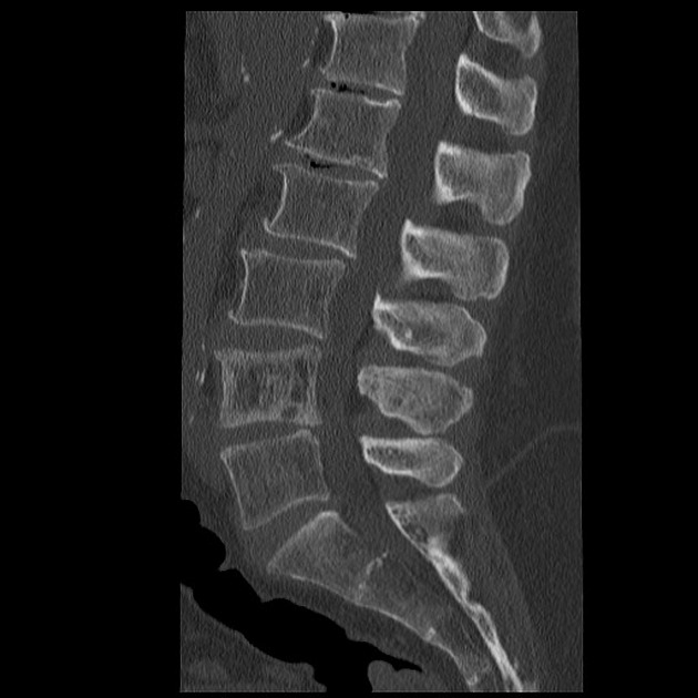 Picture Frame Vertebra - Metabolic Bone Diseases Radiology Key - The dopesheet shows only the timing of the keys, not their values, but can show the keys for many different properties at once.