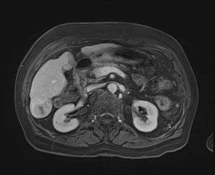 Hepatocellular carcinoma (MRI) | Image | Radiopaedia.org