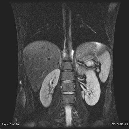 Insulinoma | Radiology Reference Article | Radiopaedia.org