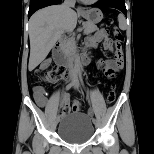 Meckel diverticulum enterolithiasis | Image | Radiopaedia.org