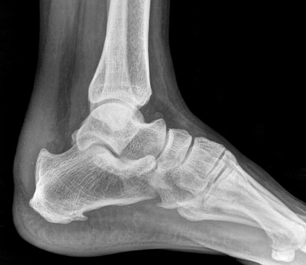 Haglund deformity | Radiology Case | Radiopaedia.org