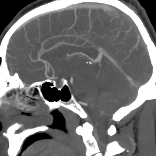 Venous thrombosis hemorrhage | Image | Radiopaedia.org