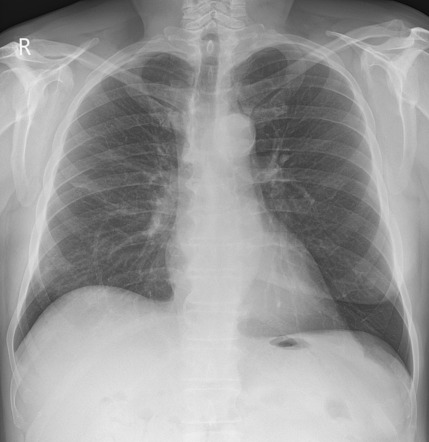 Right middle lobe pneumonia | Radiology Case | Radiopaedia.org