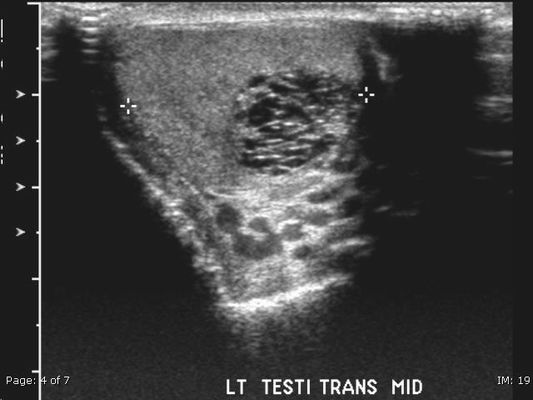 Tubular Ectasia Of Rete Testis Image