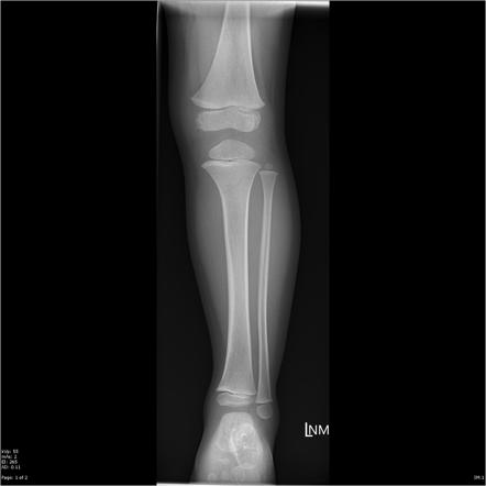 Proximal tibial fracture | Radiology Case | Radiopaedia.org