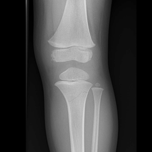 Proximal tibial fracture | Image | Radiopaedia.org