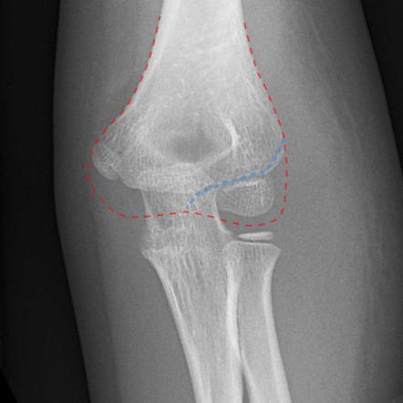 Lateral condyle fracture | Image | Radiopaedia.org