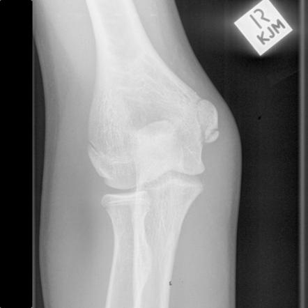 Cleft internal epicondyle | Radiology Case | Radiopaedia.org