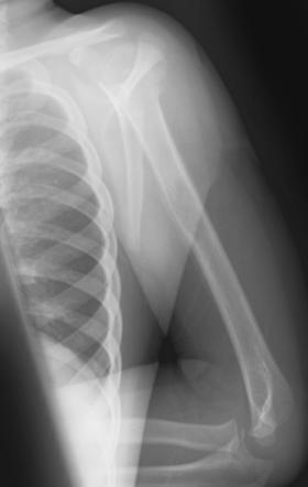 Langerhans cell histiocytosis involving right humerus | Radiology Case ...