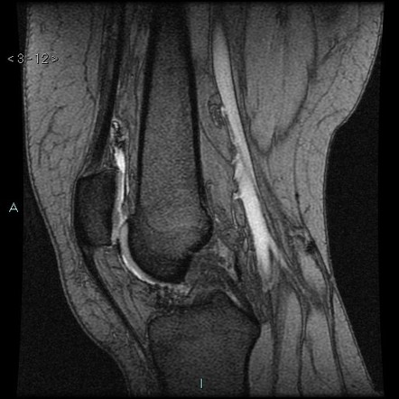 Pigmented Villonodular Synovitis – Knee 