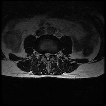 Post-laminectomy syndrome | Radiology Case | Radiopaedia.org