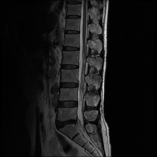 Post-laminectomy syndrome | Image | Radiopaedia.org