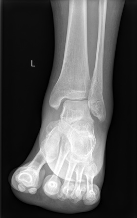 Distal Fibular Fracture (Weber B) | Image | Radiopaedia.org