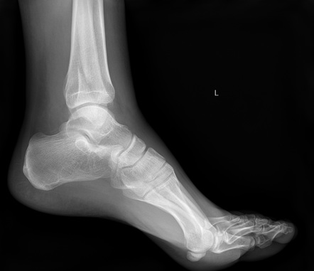 Distal fibular fracture (Weber B) | Image | Radiopaedia.org