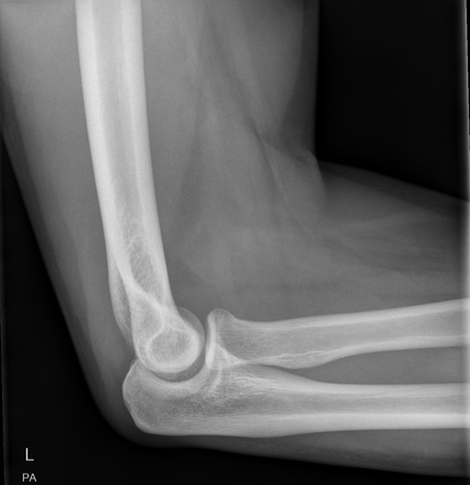 Occult radial head fracture | Image | Radiopaedia.org