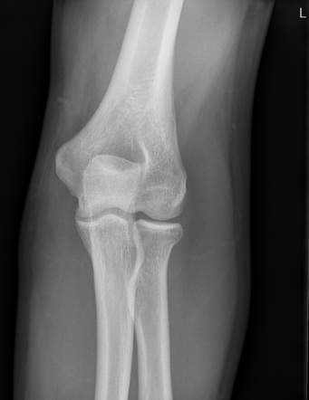 Occult radial head fracture | Radiology Case | Radiopaedia.org