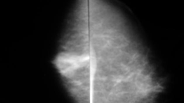 Breast Asymmetry - Radiology