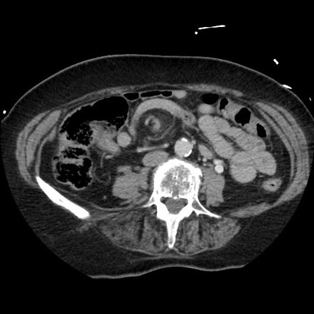 Whirlpool sign - mesentery | Radiology Case | Radiopaedia.org