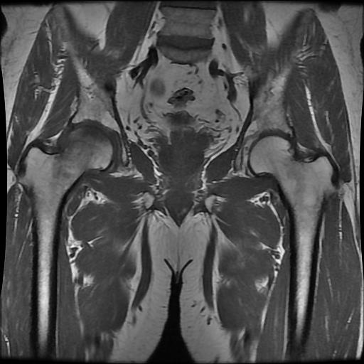 Transient Hip Osteoporosis Image