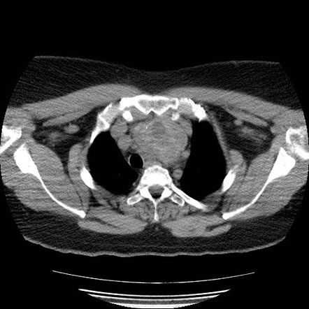 Multinodular goiter with substernal mediastinal extension | Image ...