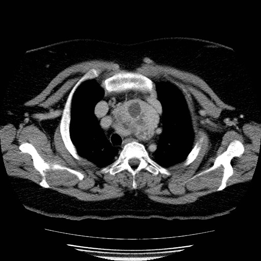 Multinodular goiter with substernal mediastinal extension | Image ...