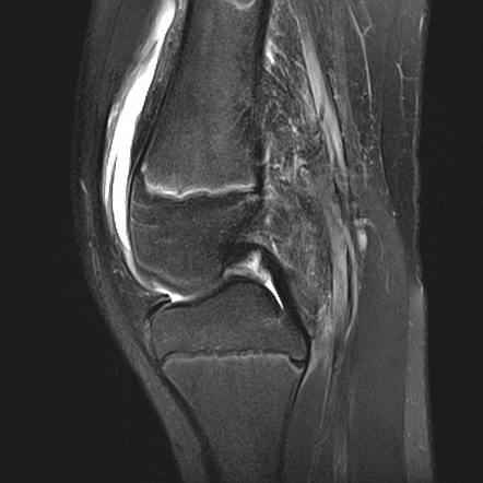 Anterior cruciate ligament tear - pediatric | Image | Radiopaedia.org