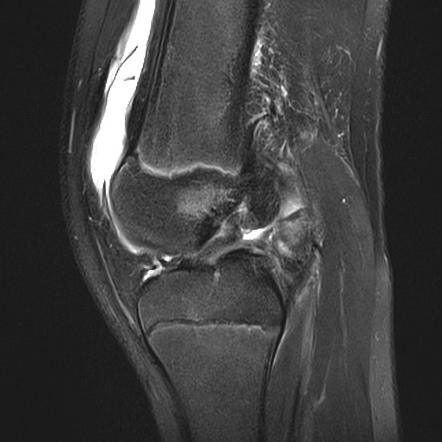 Anterior cruciate ligament tear - pediatric | Radiology Case ...