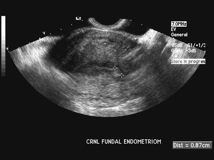 Endometrial Polyp Ultrasound Images