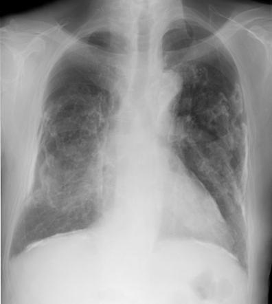 Calcified pleural plaques | Radiology Case | Radiopaedia.org