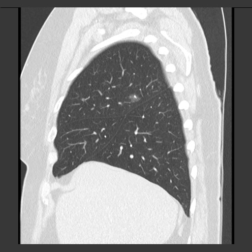 Lung Adenocarcinoma - Papillary Predominant | Image | Radiopaedia.org