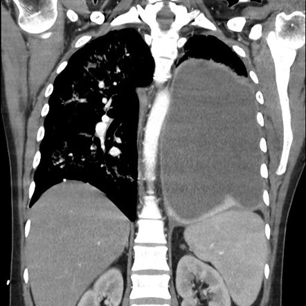 Thoracic empyema | Image | Radiopaedia.org