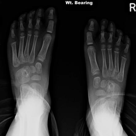 Tibialis Anterior Tendon Transfer Radiology Case Radiopaedia Org