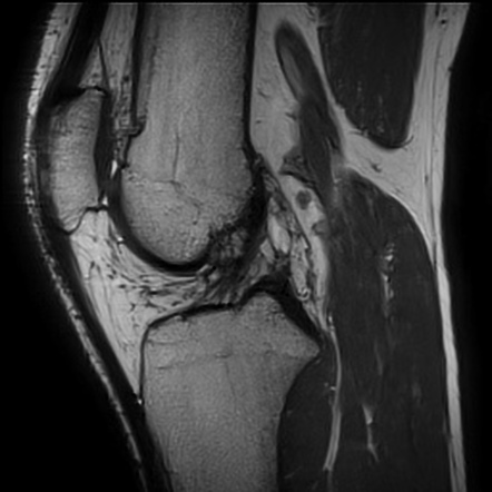 Lateral collateral ligament rupture | Image | Radiopaedia.org