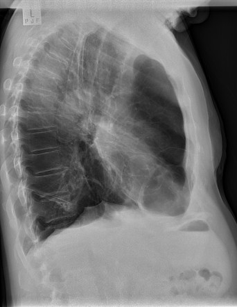 Severe bullous disease | Image | Radiopaedia.org