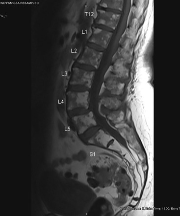 Focal fatty deposits in spinal bone marrow | Radiology Case ...