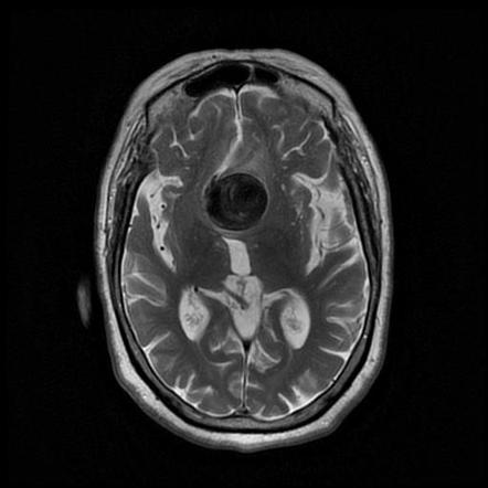 Intracranial Aneurysm