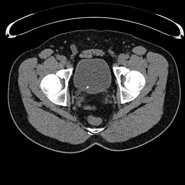 Vesicoureteric Junction Stone Radiology Case Radiopaedia Org