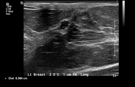 Intraductal papilloma of breast | Radiology Reference Article ...