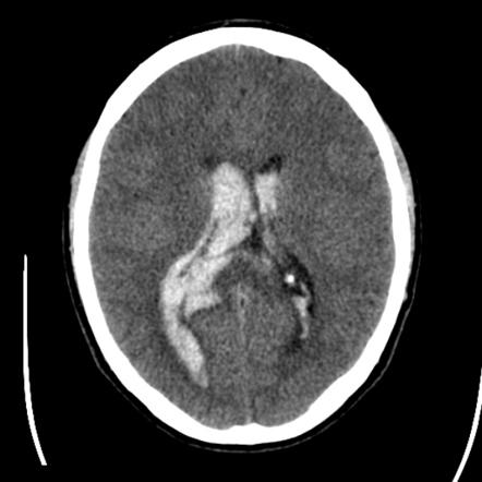 Playlist 'Intraventricular hemorrhage' by Dr Sherif Mohsen