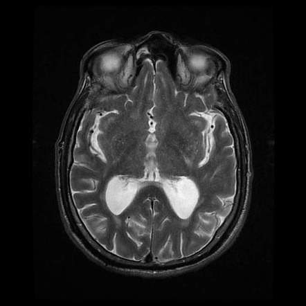 État criblé | Radiology Case | Radiopaedia.org