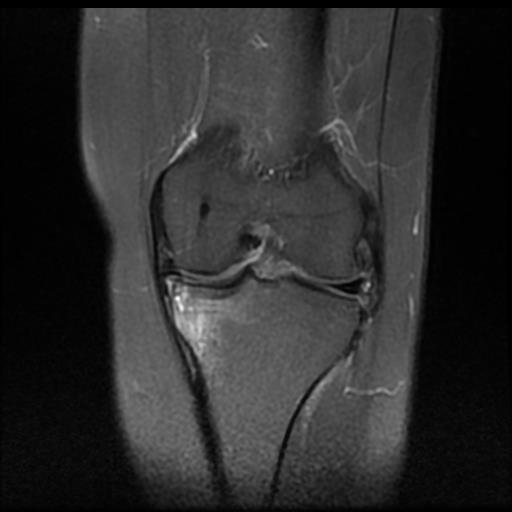 Tibial plateau insufficiency fracture | Image | Radiopaedia.org