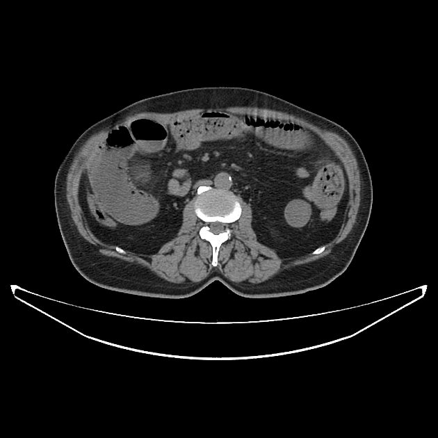 Gallstone Ileus Radiology Case Radiopaedia Org