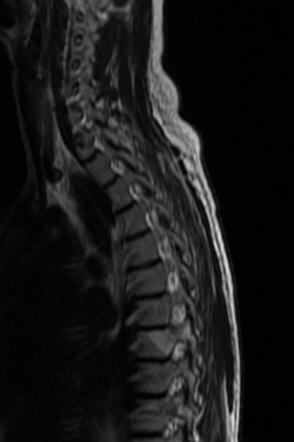 Osteoid osteoma - spine | Image | Radiopaedia.org