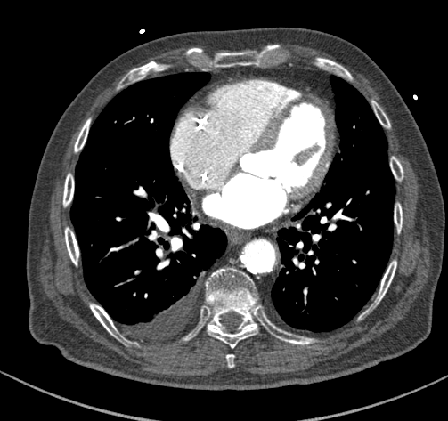 Acute myocardial infarction | Image | Radiopaedia.org