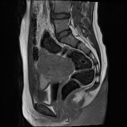 Tubo-ovarian torsion (pediatric) | Image | Radiopaedia.org