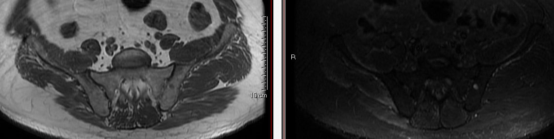 Myositis | Image | Radiopaedia.org