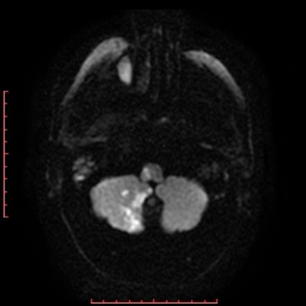 lateral pontine syndrome mri