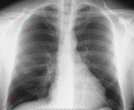 Pneumothorax: inspiratory and expiratory films | Radiology Case ...