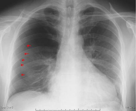 Pneumothorax | Radiology Reference Article | Radiopaedia.org